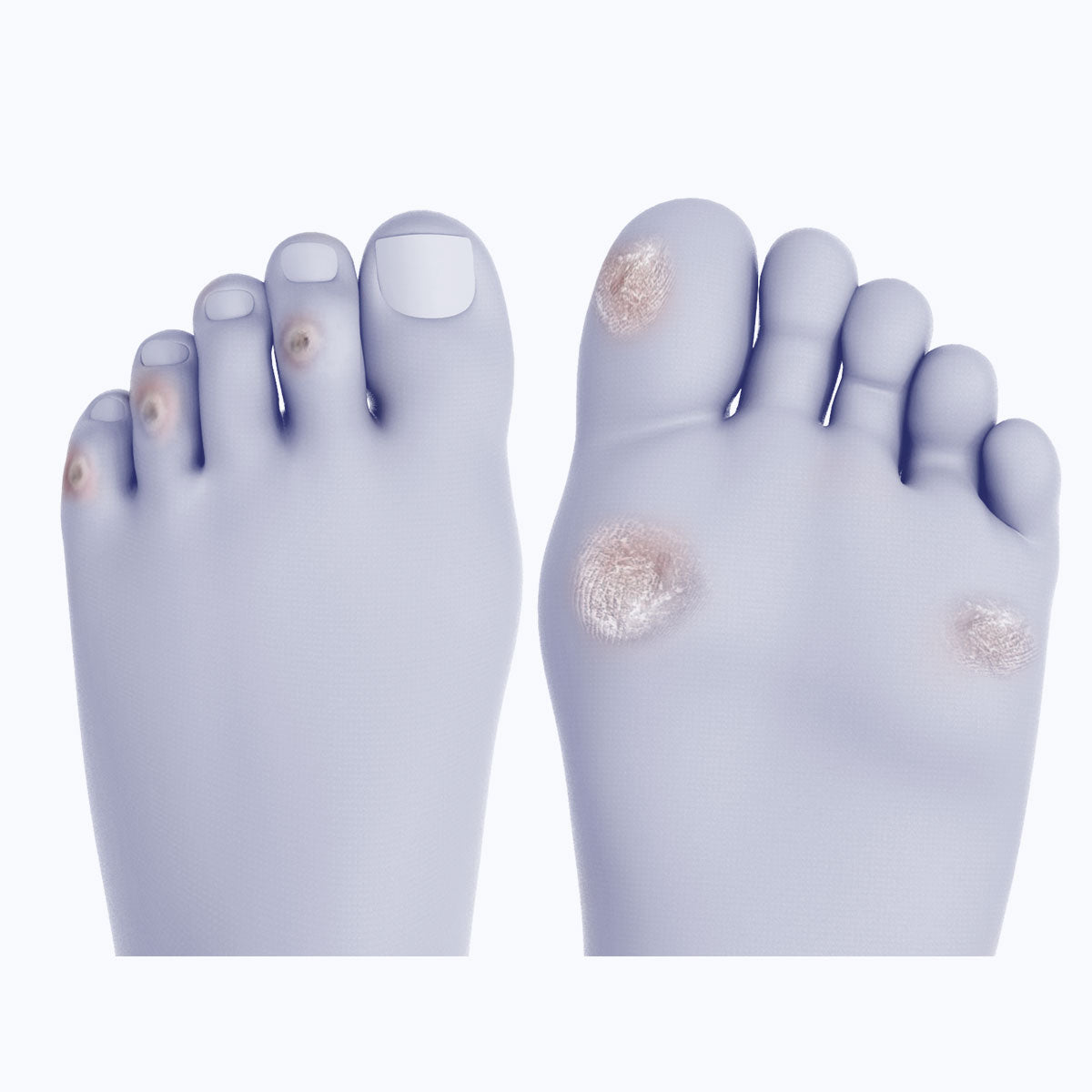 Corns and Calluses - Biopods Technologies - Biopods®